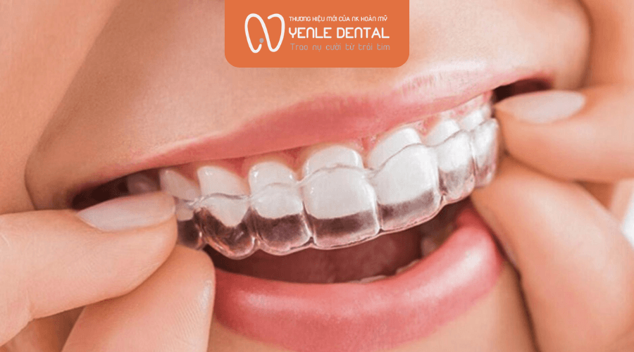 niềng răng Invisalign giá bao nhiêu